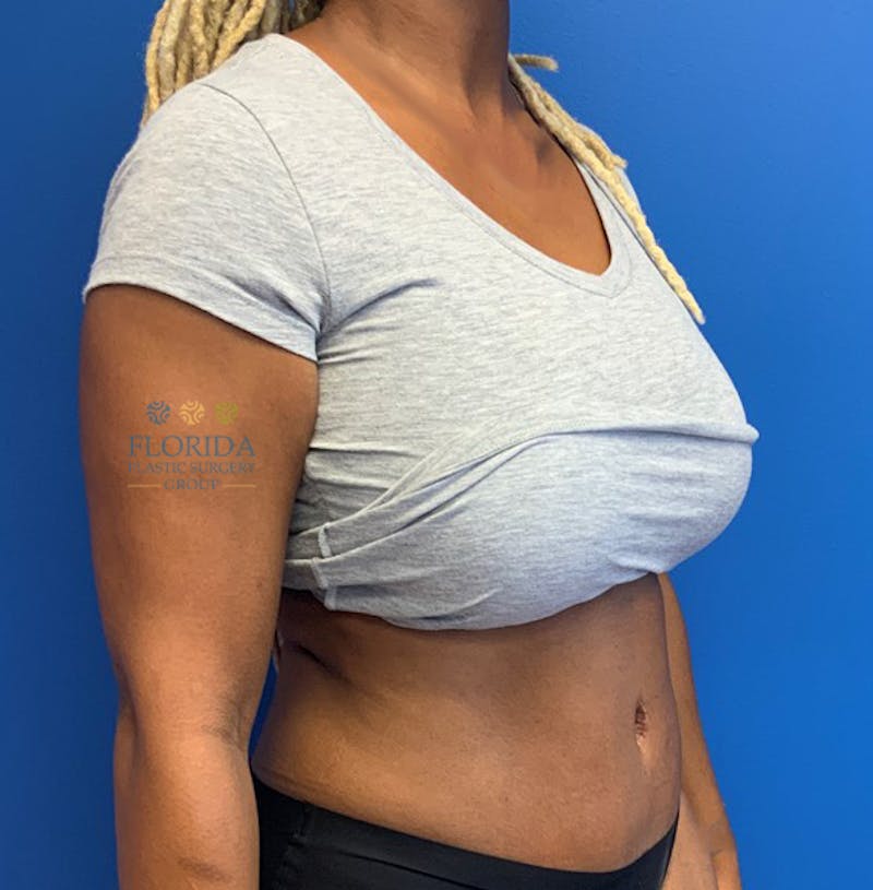 Abdominoplasty Before & After Gallery - Patient 154948970 - Image 6