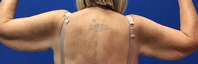 Arm Lift Before & After Gallery - Patient 154948981 - Image 1