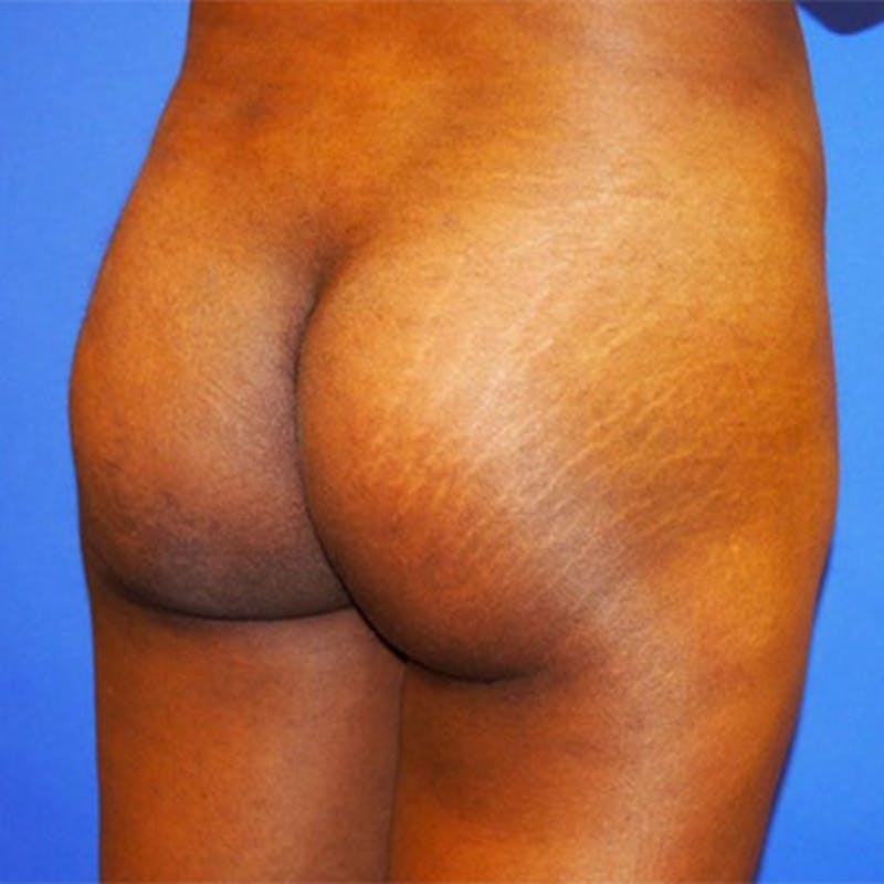 Brazilian Butt Lift Before & After Gallery - Patient 154948975 - Image 3