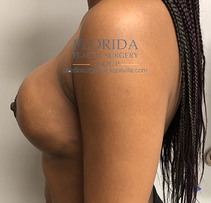 Nipple Sparing Breast Reconstruction Before & After Gallery - Patient 154948971 - Image 6