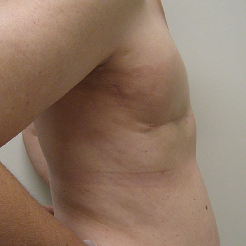Latissimus Flap Reconstruction Before & After Gallery - Patient 154948974 - Image 5