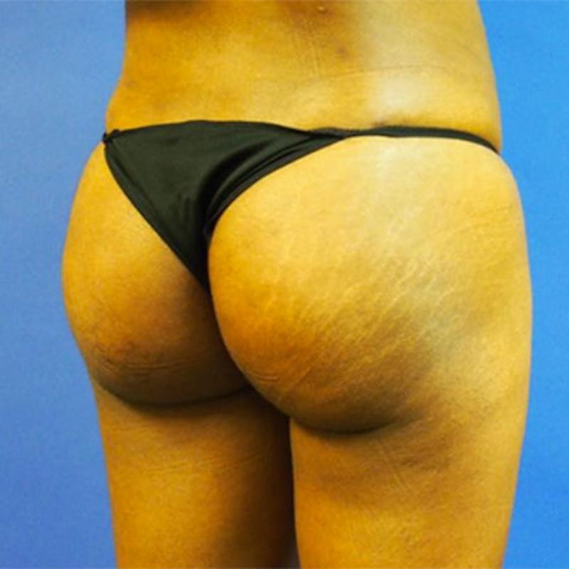 Brazilian Butt Lift Before & After Gallery - Patient 154948975 - Image 4