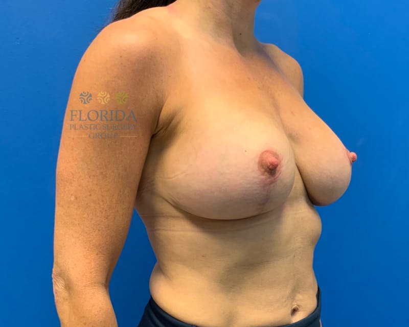 Augmentation Mastopexy Before & After Gallery - Patient 154948976 - Image 6