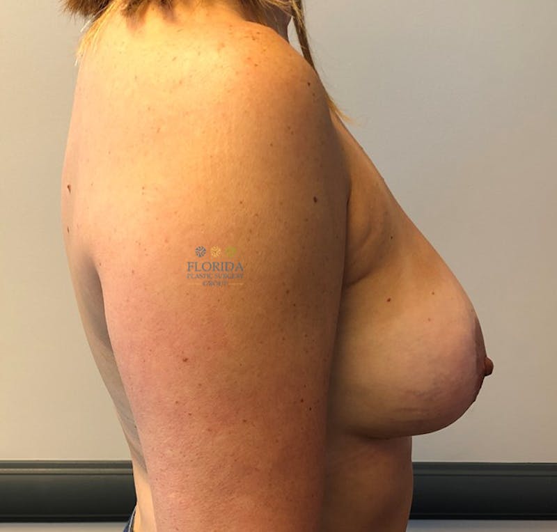 Breast Implant Removal Before & After Gallery - Patient 154948983 - Image 3