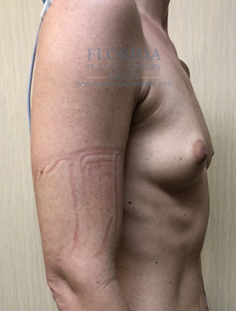 Silicone Breast Augmentation Before & After Gallery - Patient 154948982 - Image 7