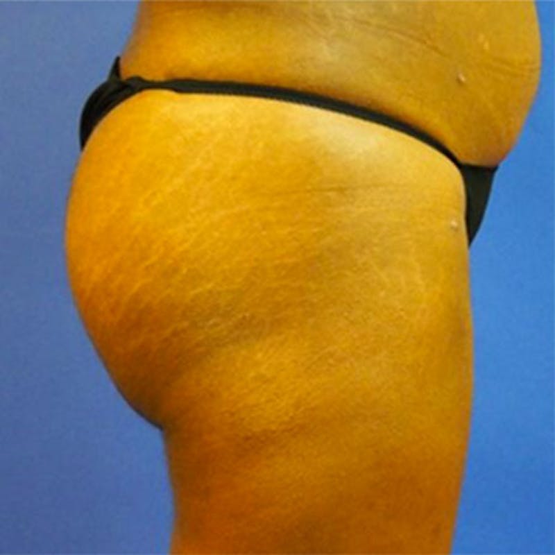 Brazilian Butt Lift Before & After Gallery - Patient 154948975 - Image 6
