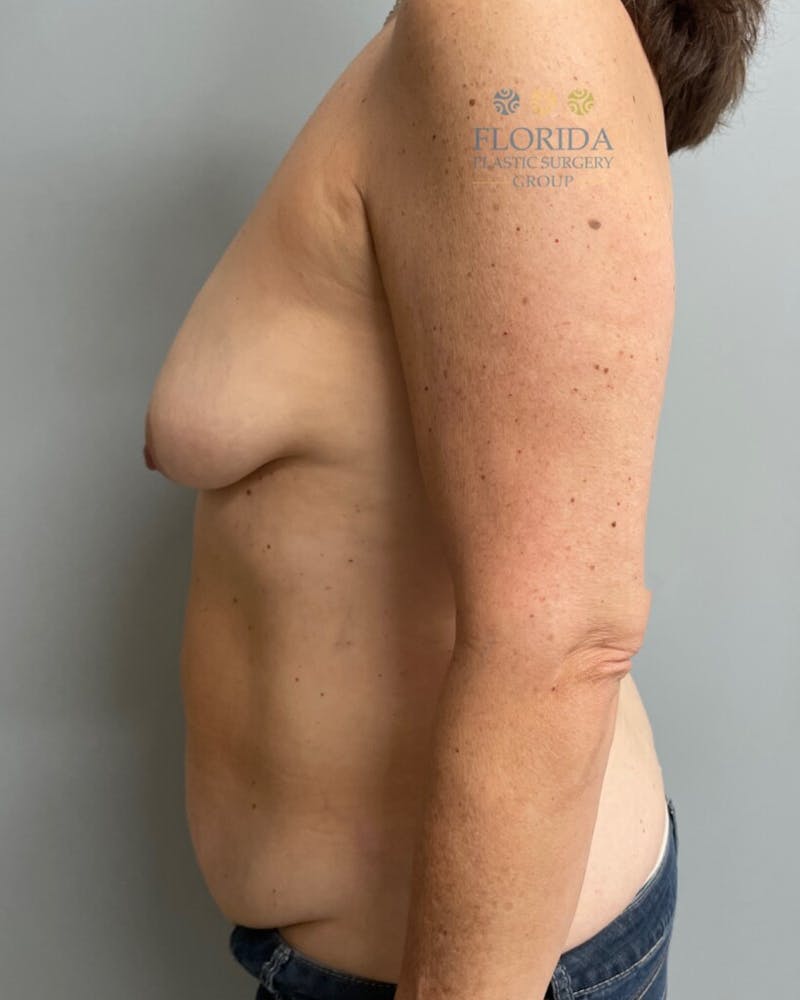 DIEP Flap Reconstruction Before & After Gallery - Patient 154948980 - Image 3