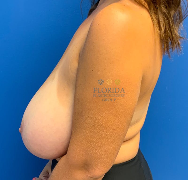 Breast Reduction Before & After Gallery - Patient 154948979 - Image 5