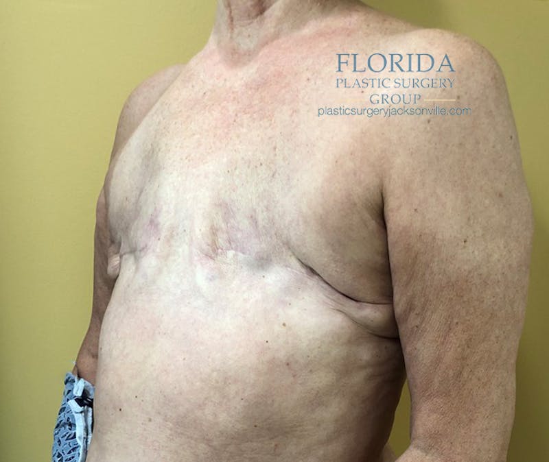 Tissue Expander Reconstruction Before & After Gallery - Patient 154948987 - Image 3