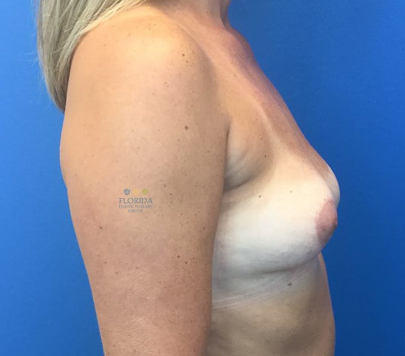 Breast Implant Removal Before & After Gallery - Patient 154948983 - Image 4