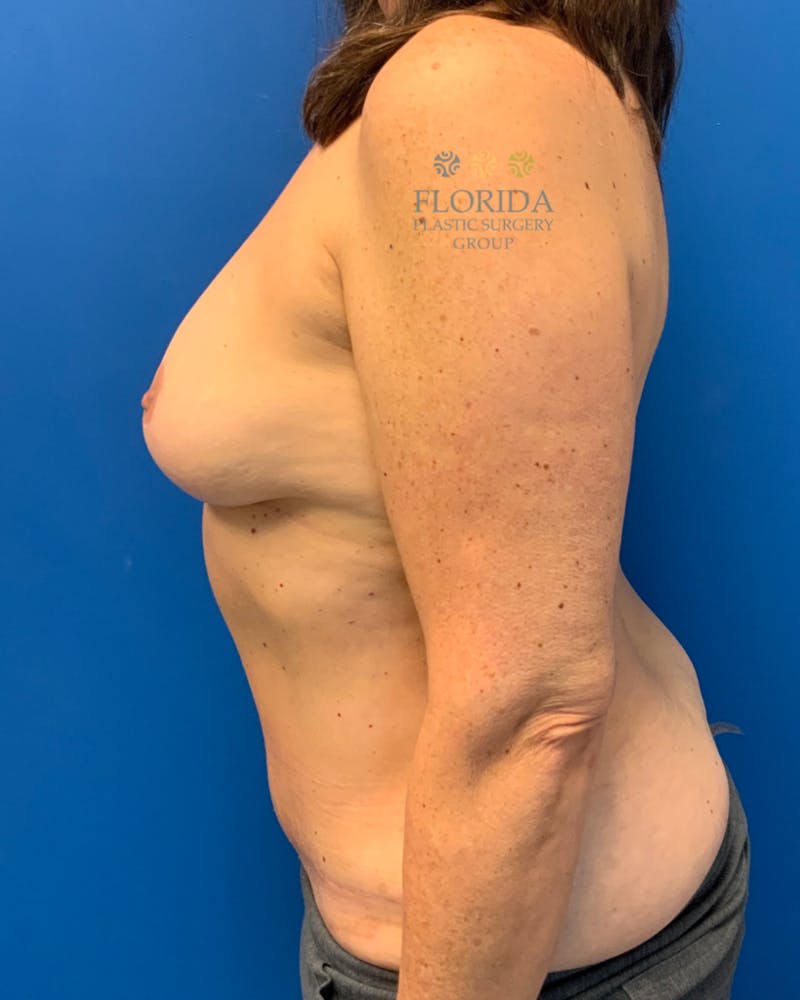 DIEP Flap Reconstruction Before & After Gallery - Patient 154948980 - Image 4