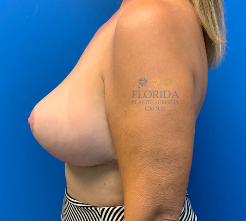 Breast Reduction Before & After Gallery - Patient 154948979 - Image 6