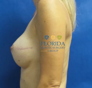 Nipple Sparing Breast Reconstruction Before & After Gallery - Patient 154948984 - Image 4