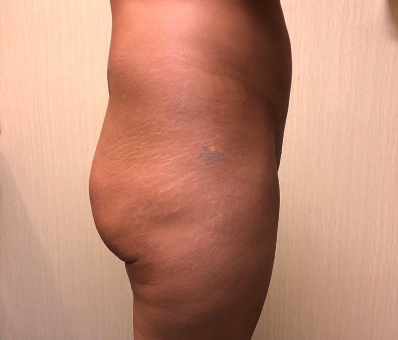 Brazilian Butt Lift Before & After Gallery - Patient 154948991 - Image 3