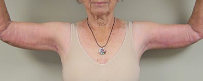 Arm Lift Before & After Gallery - Patient 154948989 - Image 2