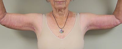 Arm Lift Before & After Gallery - Patient 154948989 - Image 2