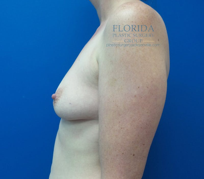 Saline Breast Augmentation Before & After Gallery - Patient 154948994 - Image 5