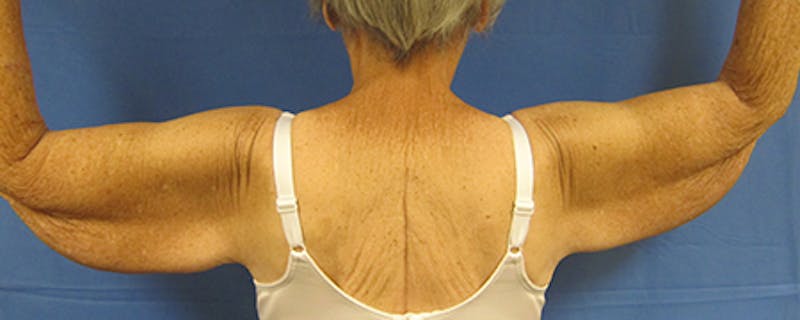 Arm Lift Before & After Gallery - Patient 154948989 - Image 3