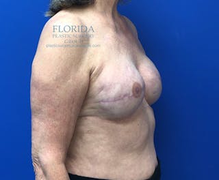 Tissue Expander Reconstruction Before & After Gallery - Patient 154948987 - Image 6
