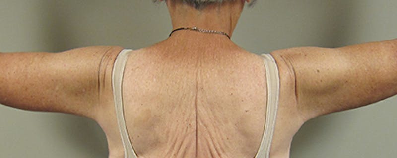 Arm Lift Before & After Gallery - Patient 154948989 - Image 4