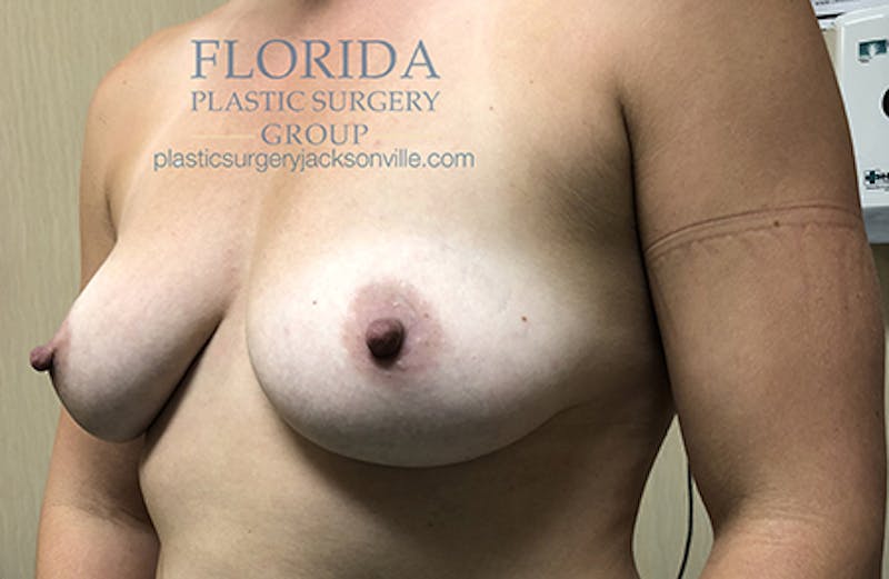 Silicone Breast Augmentation Before & After Gallery - Patient 154949010 - Image 3
