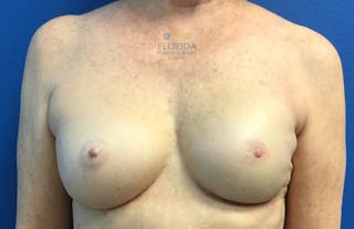 Nipple Sparing Breast Reconstruction Before & After Gallery - Patient 154949003 - Image 2