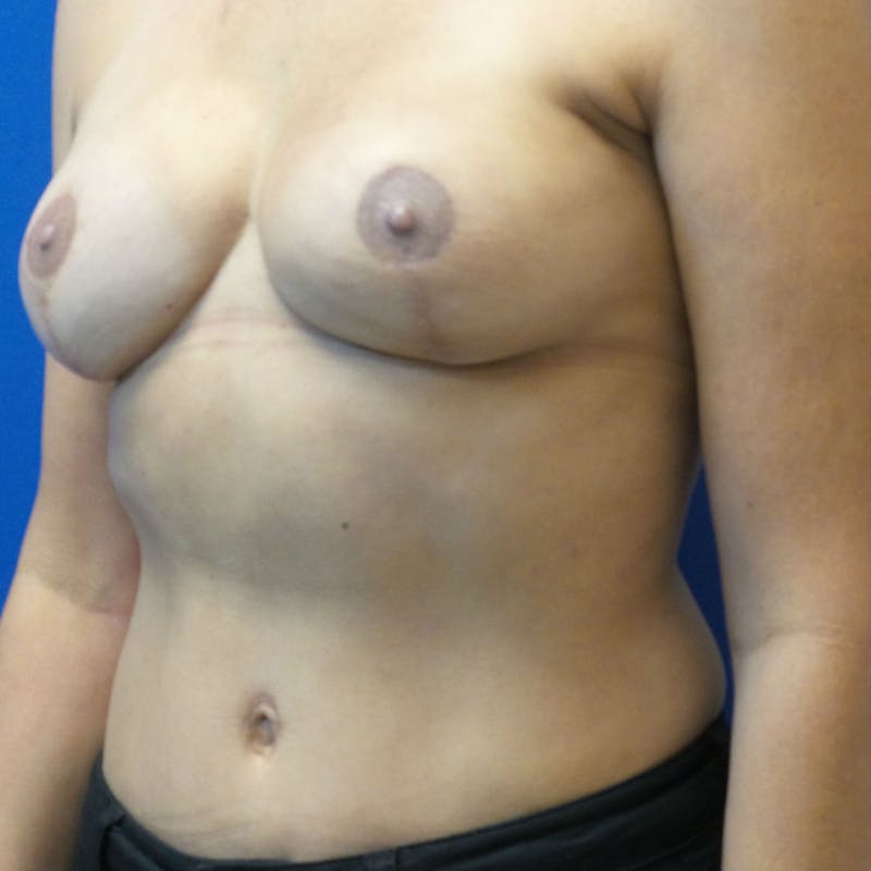 DIEP Flap Reconstruction Before & After Gallery - Patient 154948992 - Image 4