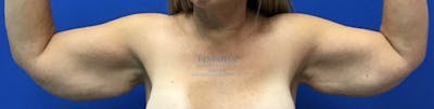 Arm Lift Before & After Gallery - Patient 154949015 - Image 1