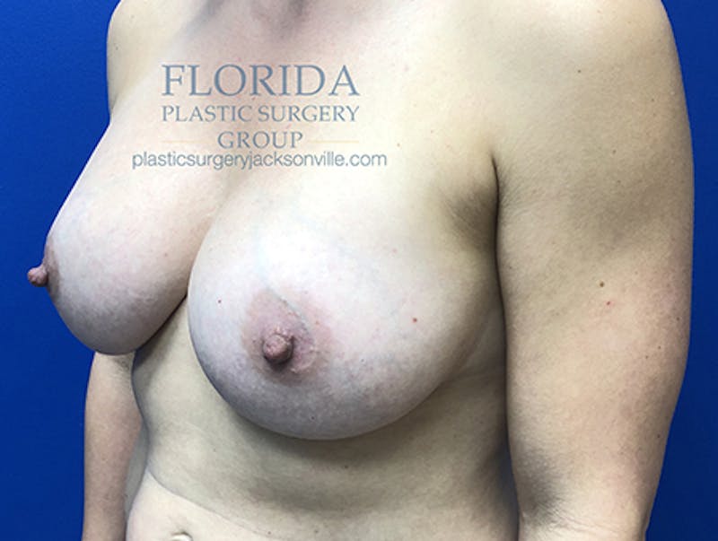 Silicone Breast Augmentation Before & After Gallery - Patient 154949010 - Image 4