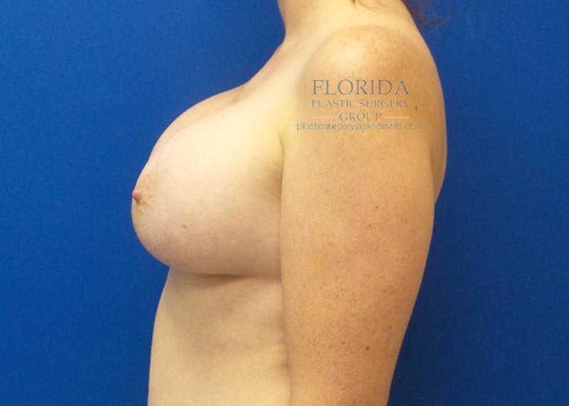 Saline Breast Augmentation Before & After Gallery - Patient 154948994 - Image 6