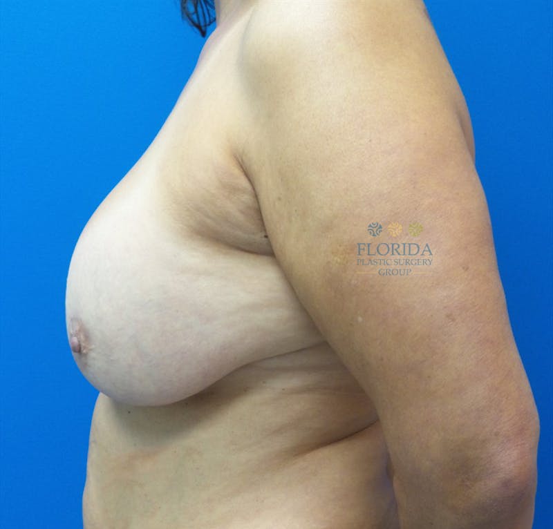 Breast Implant Removal Before & After Gallery - Patient 154949005 - Image 3