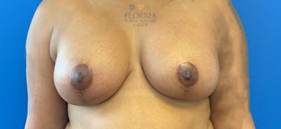Augmentation Mastopexy Before & After Gallery - Patient 154949002 - Image 2