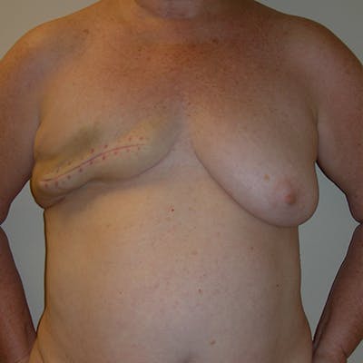 DIEP Flap Reconstruction Before & After Gallery - Patient 154949007 - Image 1