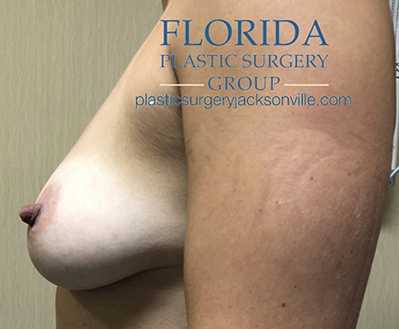 Silicone Breast Augmentation Before & After Gallery - Patient 154949010 - Image 5
