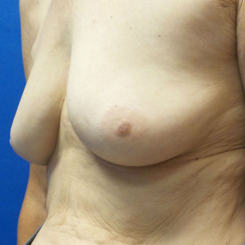 Tissue Expander Reconstruction Before & After Gallery - Patient 154948997 - Image 3