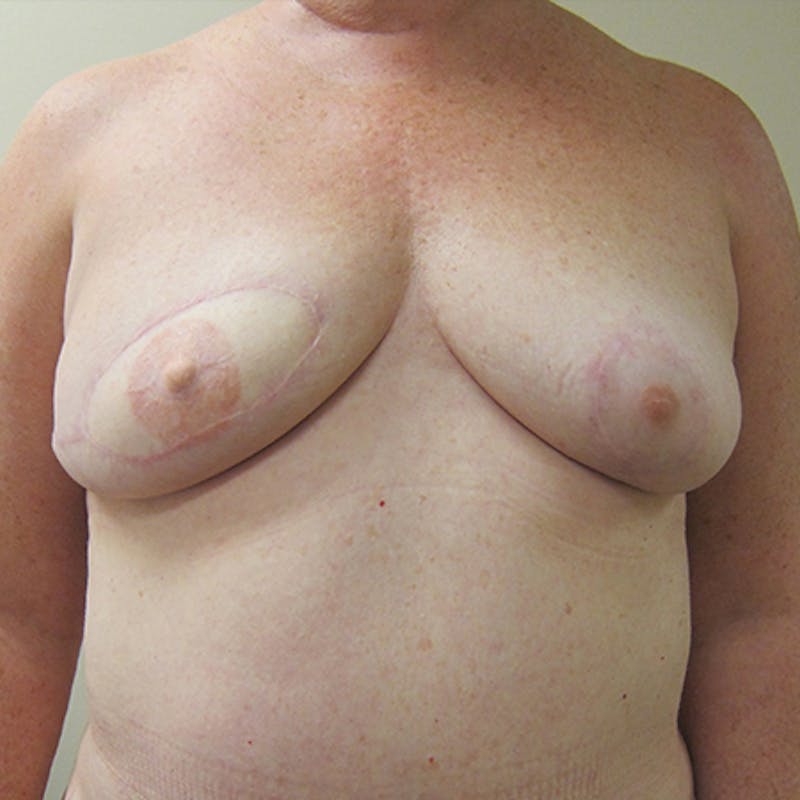 DIEP Flap Reconstruction Before & After Gallery - Patient 154949007 - Image 2