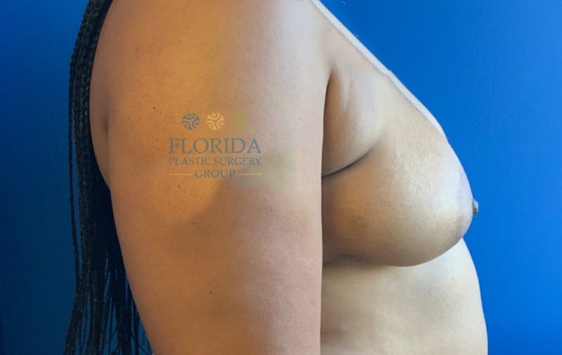 Augmentation Mastopexy Before & After Gallery - Patient 154949002 - Image 3