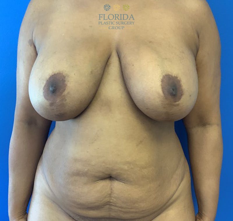 Abdominoplasty Before & After Gallery - Patient 154949017 - Image 1