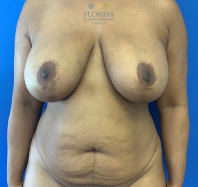 Abdominoplasty Before & After Gallery - Patient 154949017 - Image 1