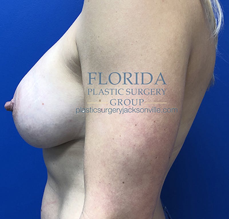 Silicone Breast Augmentation Before & After Gallery - Patient 154949010 - Image 6