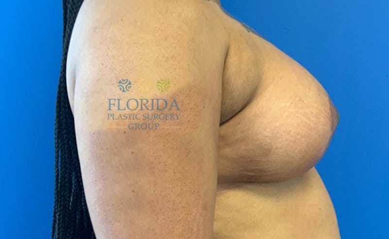 Augmentation Mastopexy Before & After Gallery - Patient 154949002 - Image 4