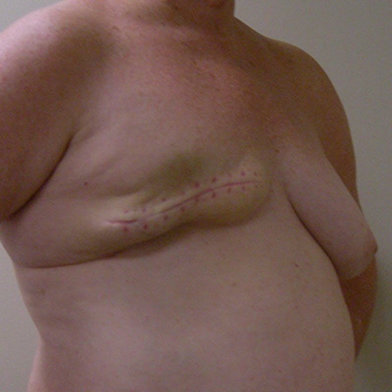DIEP Flap Reconstruction Before & After Gallery - Patient 154949007 - Image 3