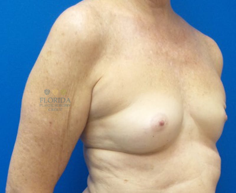 Nipple Sparing Breast Reconstruction Before & After Gallery - Patient 154949003 - Image 5