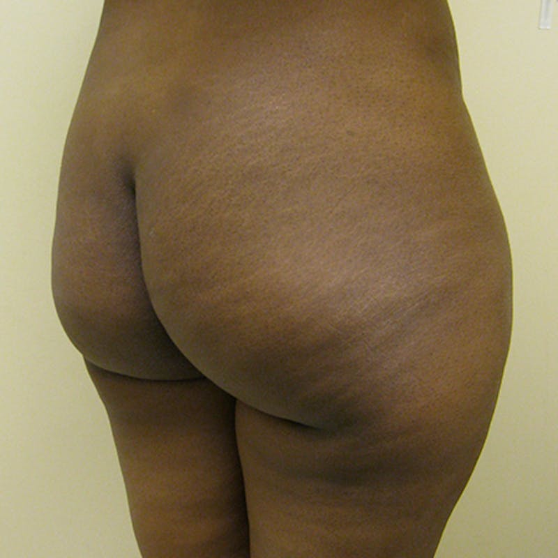 Brazilian Butt Lift Before & After Gallery - Patient 154949014 - Image 3