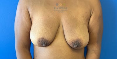 Augmentation Mastopexy Before & After Gallery - Patient 154949023 - Image 1