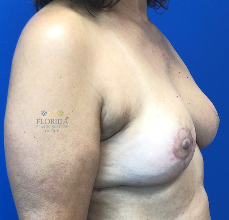 Breast Implant Removal Before & After Gallery - Patient 154949005 - Image 6