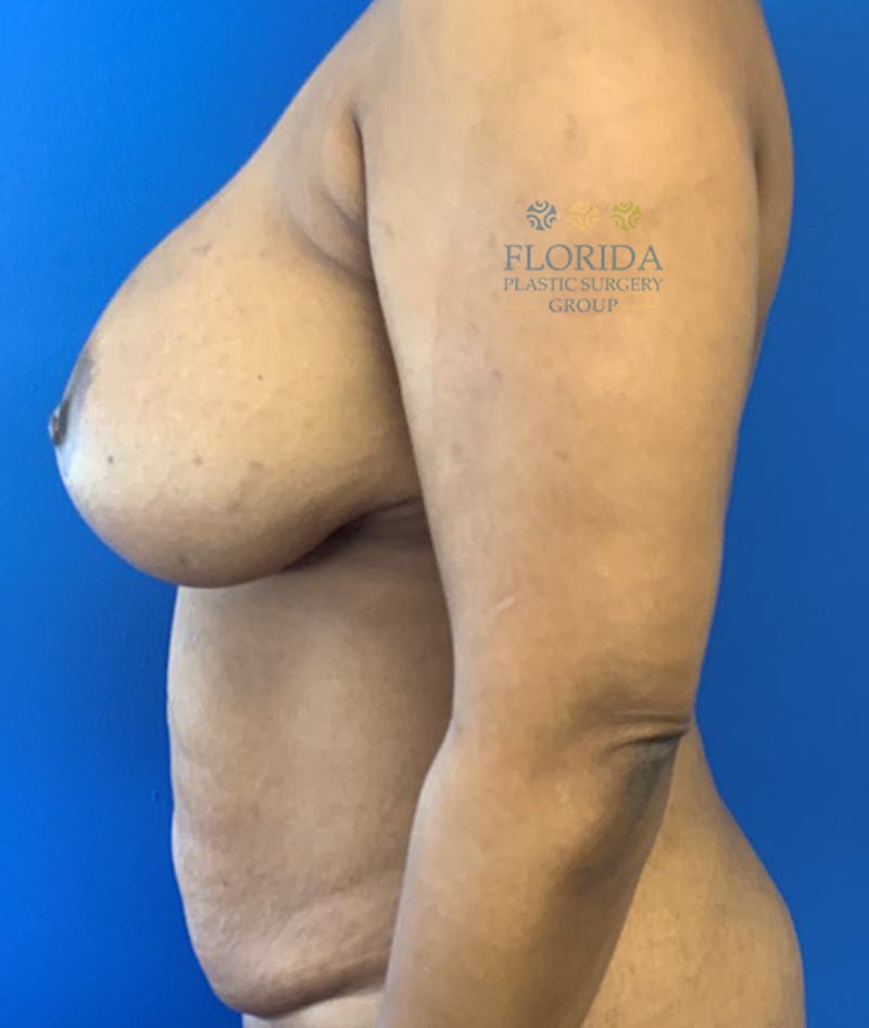 Abdominoplasty Before & After Gallery - Patient 154949017 - Image 3