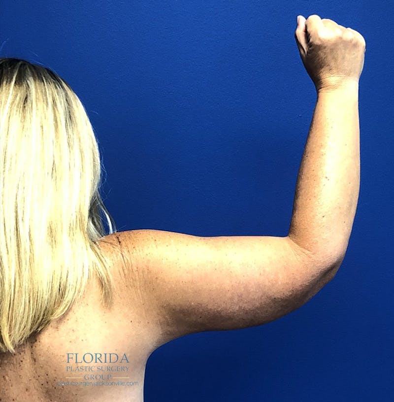 Arm Lift Before & After Gallery - Patient 154949015 - Image 6