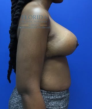 Breast Reduction Before & After Gallery - Patient 154949009 - Image 4