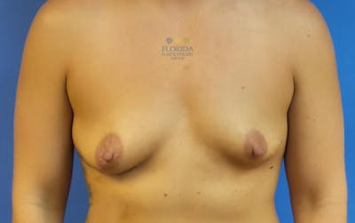 Nipple Sparing Breast Reconstruction Before & After Gallery - Patient 154949020 - Image 1